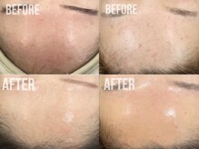 煌(kirameki)/【ニキビ】毛穴洗浄＋micostella