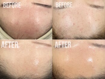 煌(kirameki)/【ニキビ】毛穴洗浄+micostella