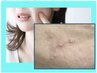 ★ニキビ専門★今まで何をしても肌改善出来なかった方のクーポン★相談＋施術