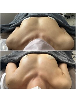 モア(moa)/授乳後バストとハリ復活!