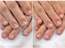 リファーレ(RIFARE)/【メンズ深爪矯正初回】