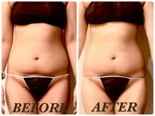 プリマ(Prima)/【2回施術】　BEFORE&AFTER