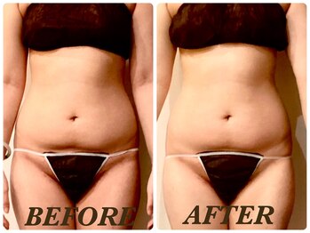 プリマ(Prima)/【2回施術】 BEFORE&AFTER