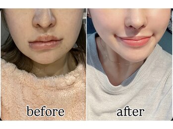 ミカド 銀座(mikado)/輪郭3点術後/術後インディバケア