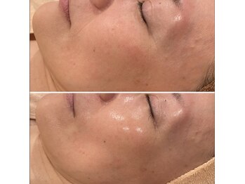 トータルエステティック ジョワイユ(JOYEUX)/どちらも施術前に撮影