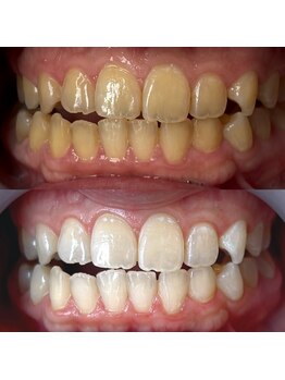 ワールドビューティー(World Beauty)/30代女性/ホワイトニング　6回