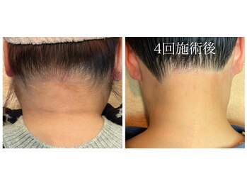 シフォン(Chiffon)/うなじ脱毛