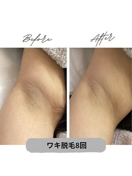 プレジール 大野城店(plaisir)/ワキ脱毛