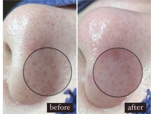 エミング(yeming)/★毛穴エクストラクション★