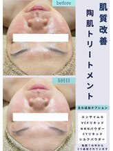 クレヴィー(Creviy)/本気の肌質改善ハーブピーリング