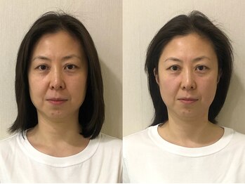 リス(R.i.S)/小顔矯正Before&After