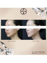 ココセンガビューティークリニック 恵比寿(COCO SENGA Beauty-Clinic)/【PLA PEEL】before/after