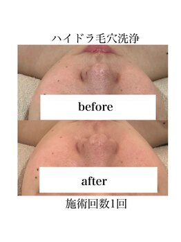 サラ/ハイドラ毛穴洗浄
