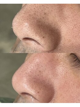 スタジオベッロ 神戸三ノ宮店(studio bello)/オプションWax（額、小鼻、頬）