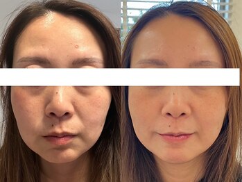 サクラ 本厚木駅前店(SAKURA)/シミケア/たるみケア/小顔/美肌