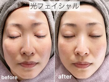 ブルーム(Bloom.)/光フェイシャル