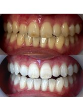 ワールドビューティー(World Beauty)/30代女性/ホワイトニング　6回