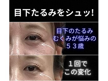 目元 口元のたるみ 眉間シワ改善専門サロン/目下のたるみを改善したい方向け