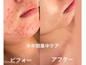 毛穴ケア　アドバンスコース+ピーリングパック100分￥8800→￥3850