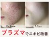 【ニキビゼロのお肌へ】アクネ菌殺菌で徹底ニキビケア☆ハーブピーリング