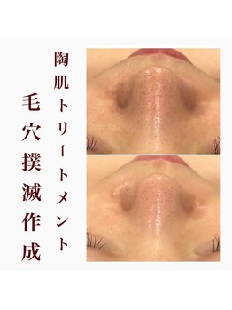 心斎橋 ルヴィ(REVI)/ハーブピーリングの変化