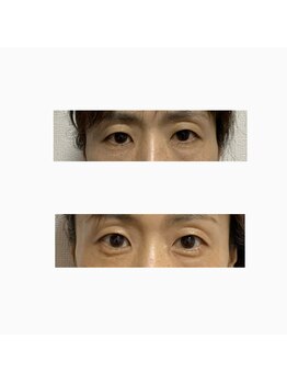 ナチュライズ(NatuRise)/涙袋