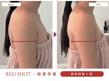 ハレア(HALEA)/レッドショット二の腕 4cc B/A