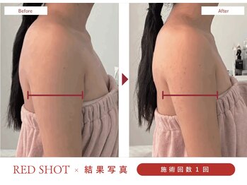 ハレア(HALEA)/レッドショット二の腕 4cc B/A