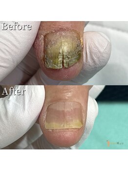 巻き爪補正店 八幡店/変形爪再生補正 NO.5