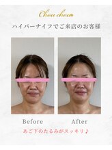 シュシュ(Chouchou)/ハイパーナイフ1回