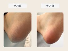 ルポ 伊勢/かかと角質ケア