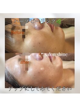 サロンシャイン(Salon Shine)/ハーバルピールレベル7