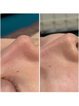 ミューモア(MiuMoa)/毛穴洗浄