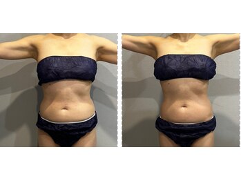 ラヴィエール(Laviere)/レディース痩身120分