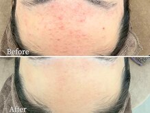 エステ ニキビケア研究所 川崎店/ おでこニキビケア