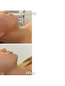 エムボーテ 太田店(M BEAUTE33)/顔筋小顔コルギ