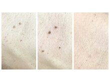 ルル(RuRu)/イボケア