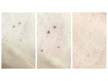 ルル(RuRu)/イボケア