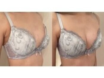 美人バスト 豊橋店/バストアップ症例【バストケア】