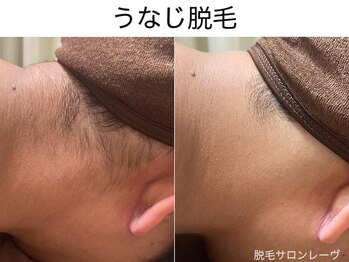レーヴ/☆うなじ脱毛の効果☆