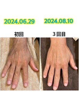 ルーチェ/【脱毛箇所】手の甲・指