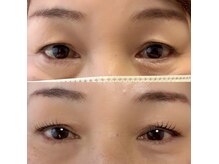 アクイール シュエットの雰囲気（コンプレックス解消、瞼のリフトアップ）