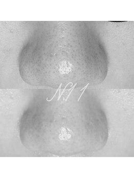 エヌ ドット ジュウイチ(N.11)/黒ずみ毛穴洗浄