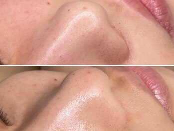 エイプリルフールズ(April fools)/みんな気になる毛穴の黒ずみ撃退