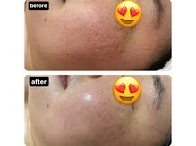 ヒラキヒミ。/毛穴洗浄エステ+ヘッドスパ