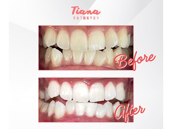 ティアナ 徳島店(Tiana)/ホワイトニング Before&After