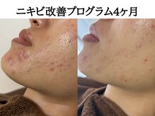 アエオボンヌール(A.E.O BONHEUR)/顎　頬ニキビ改善経過