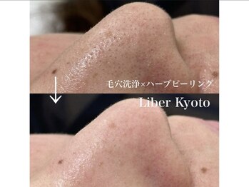 エステティック リベル キョウト 京都駅前店(Esthetic Liber Kyoto)/毛穴洗浄×ハーブピーリング