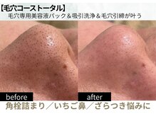 ラカ 長野駅前本店(LaKa)の雰囲気（毛穴吸引洗浄で施術後の違い実感！いちご鼻/角栓/毛穴洗浄）