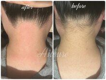 エルール トータルビューティ(Aileure total beauty)/うなじ美人　うなじ脱毛